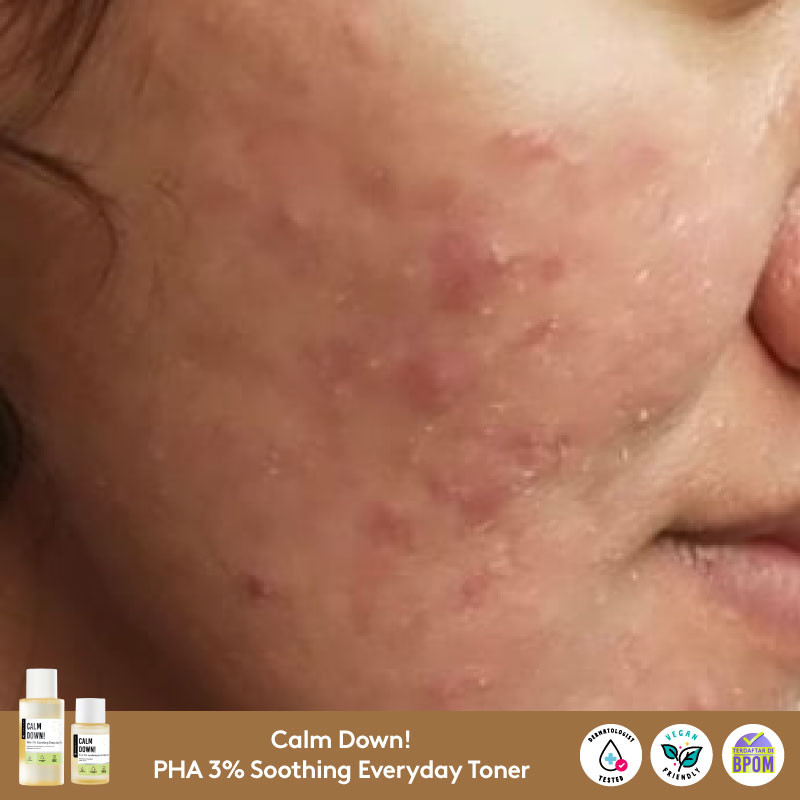 Buy somethinc calm down pha 3 soothing everyday toner original best deals